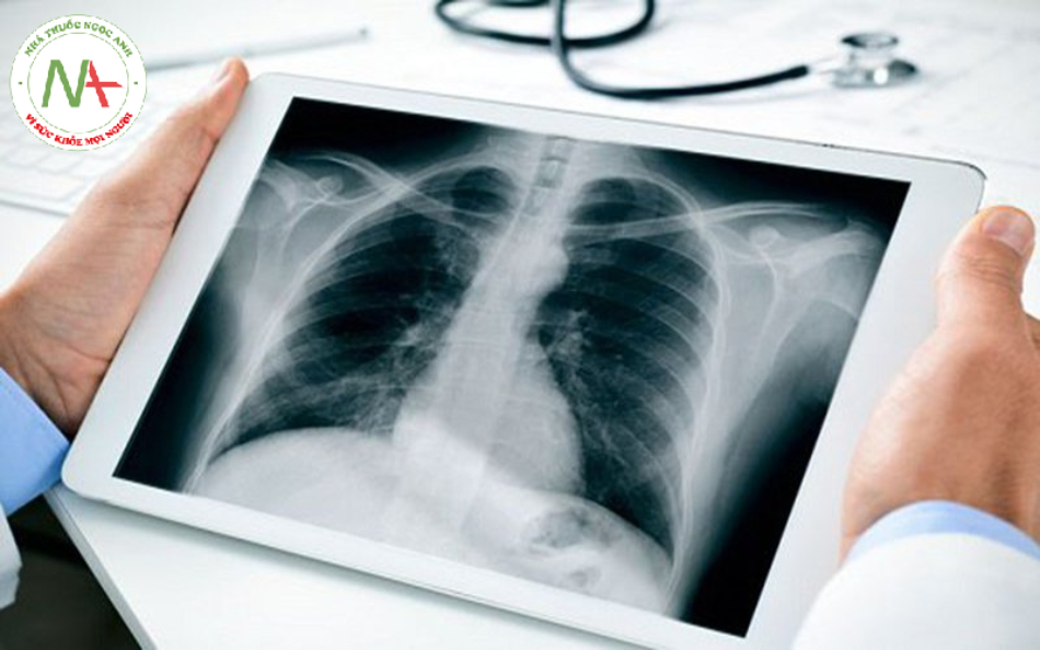 Chẩn đoán viêm phế quản cấp bằng chụp X quang phổi