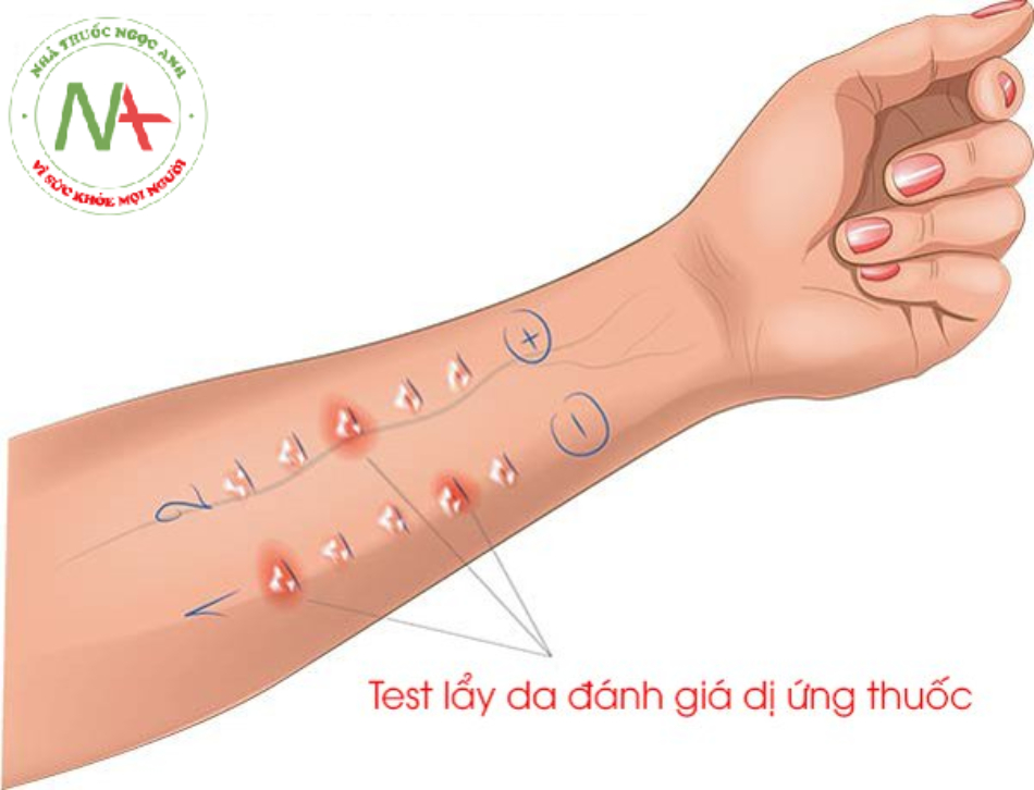 Test lẩy da nhằm đánh giá phản ứng của cơ thể với dị nguyên