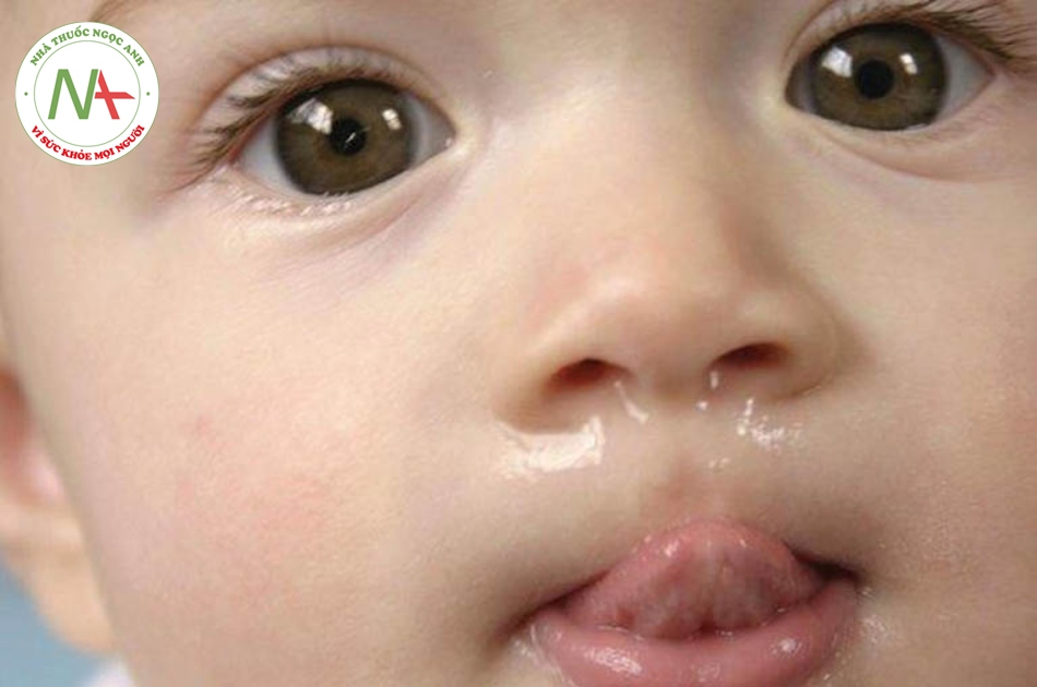 Cách giảm nghẹt mũi ở trẻ bị cúm