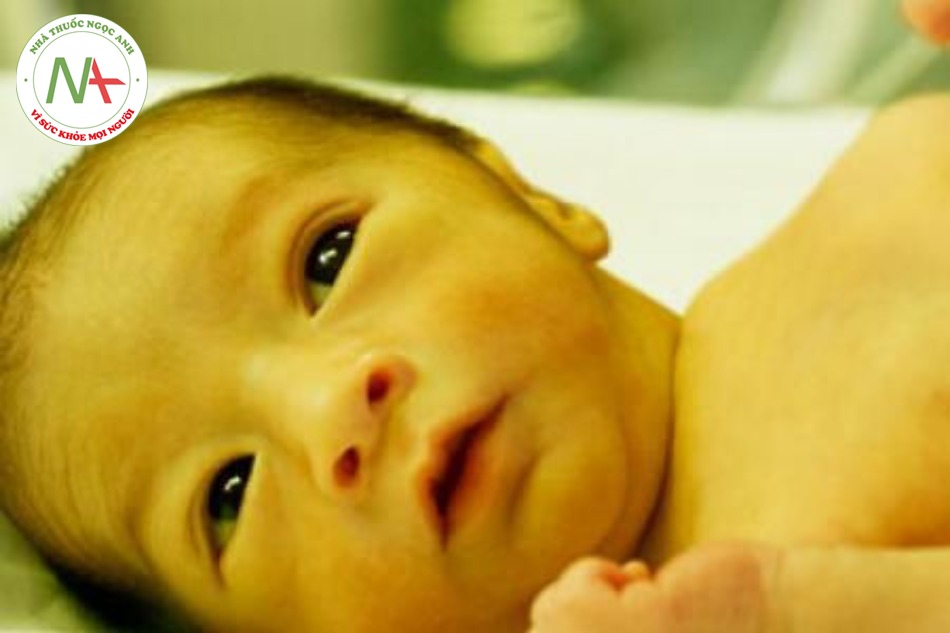 Chỉ số bilirubin cao có thể gây vàng da ở trẻ sơ sinh