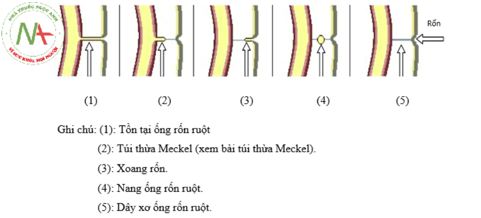 Sự tồn tại của ống rốn ruột có thể gây thành hậu quả nặng nề