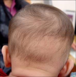 bệnh rụng tóc ở trẻ em