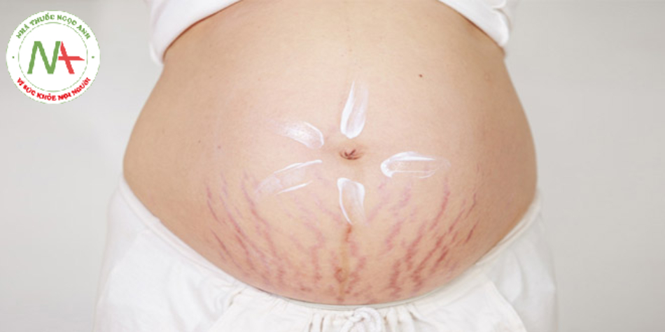 Rạn da trong quá trình mang thai 