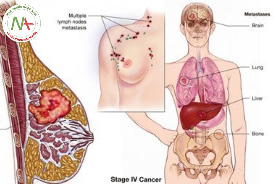 Liệu pháp thay thế hormone có làm tăng nguy cơ ung thư vú không?