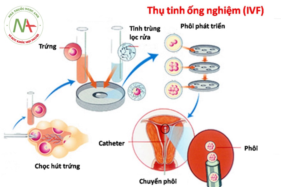 Quy trình IVF - thụ tinh trong ống nghiệm