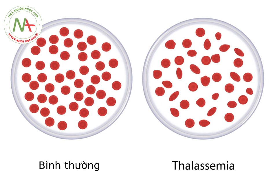 Cách chẩn đoán bệnh Thalassemia
