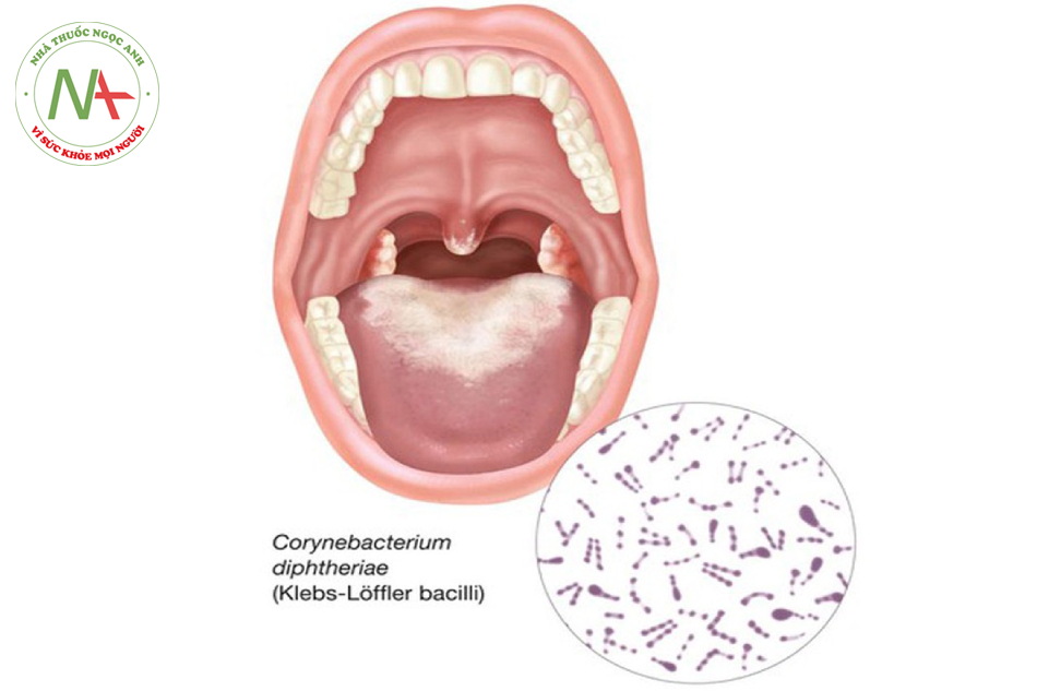 Bệnh bạch hầu do vi khuẩn Corynebacterium diphtheriae gây ra