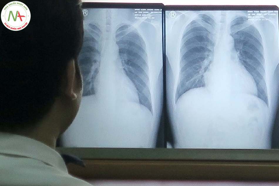 Hình ảnh chẩn đoán tràn khí màng phổi ở bệnh nhân thở máy