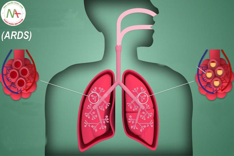 Hội chứng suy hô hấp cấp tiến triển (ARDS)