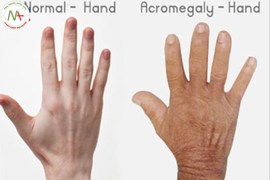 Hình ảnh bàn tay bình thường và bệnh to đầu chi