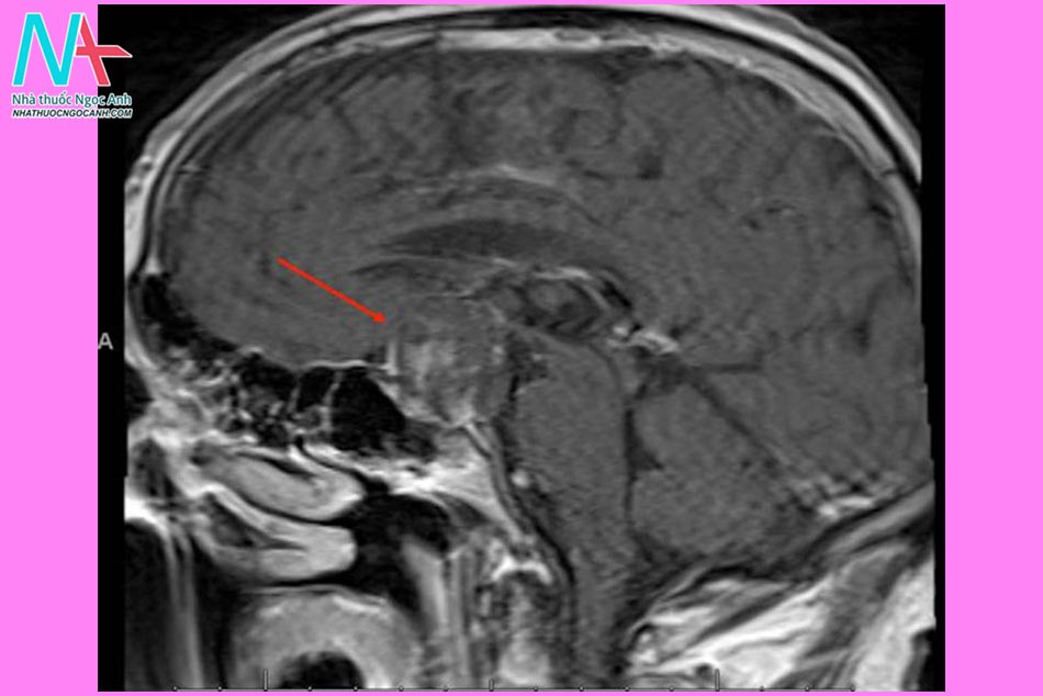 Khối u tuyến yên được chẩn đoán tốt nhất bằng MRI hoặc chụp cắt lớp vi tính tập trung vào tuyến yên