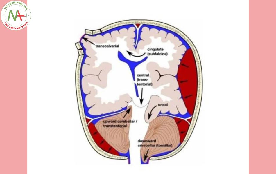 Tổng quan về dị dạng động tĩnh mạch não