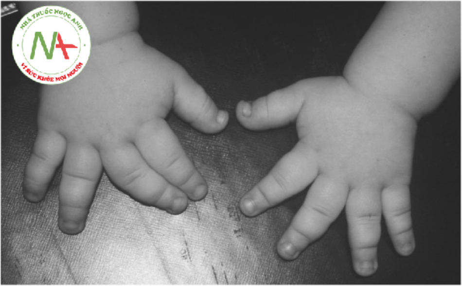 Các ngón tay ngắn và cấu hình bàn tay giống như đinh ba