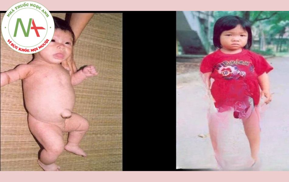 Hình ảnh: Suy giáp bẩm sinhCháu Ng. Q. Th. 12 tháng tuổi và cháu Đ. T. H.Q 7 tuổi, SGBS
