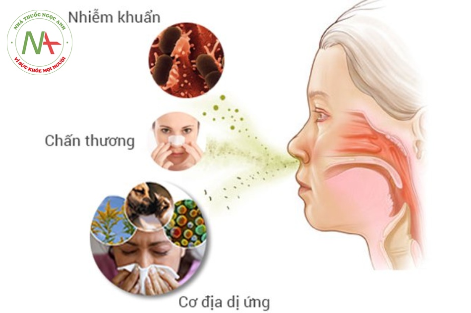 Có thể ngăn ngừa bệnh viêm mũi xoang không?