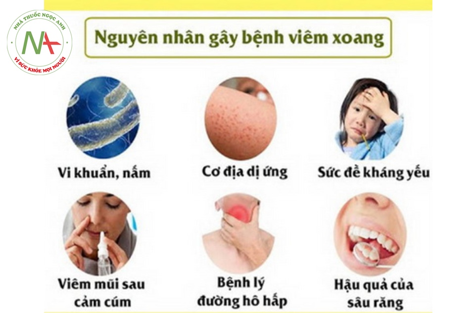 Virus là nguyên nhân phổ biến gây viêm mũi xoang