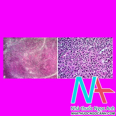 Hình 1. A. Mô hạch có vùng mất cấu trúc nang lympho (HEx100).  B. Tế bào u nhân nhỏ và trung bình, bào tương hẹp, xen lẫn tế bào nhân lớn (HEx200).