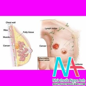 Hình ảnh minh họa tuyến vú và ung thư vú (Nguồn: Internet)