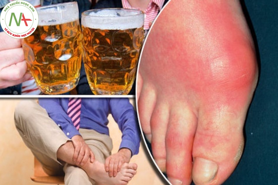 Người bị bệnh gout nên kiêng uống rượu bia