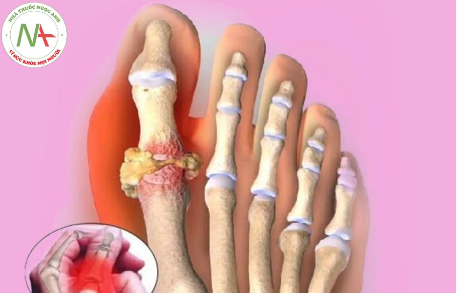 Thuốc điều trị gout