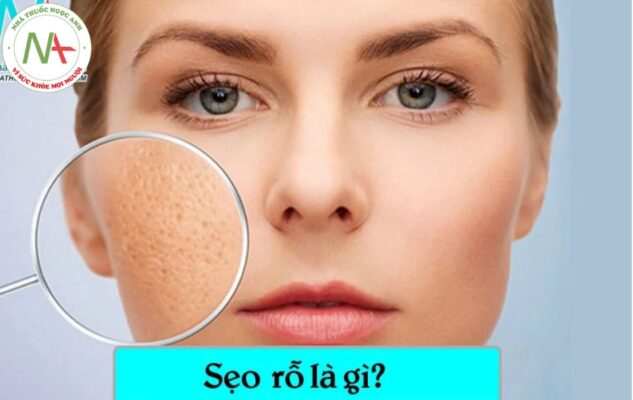 Sẹo rỗ là gì?