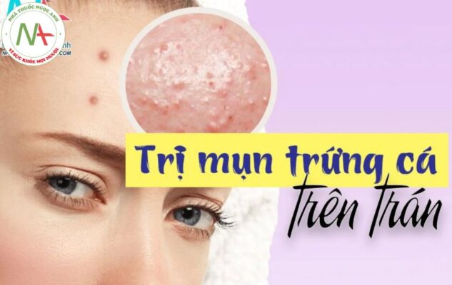 Tại sao mụn trứng cá mọc nhiều trên trán?