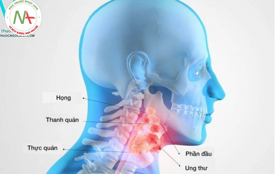 Dấu hiệu nhận biết của ung thư vòm họng giai đoạn 2