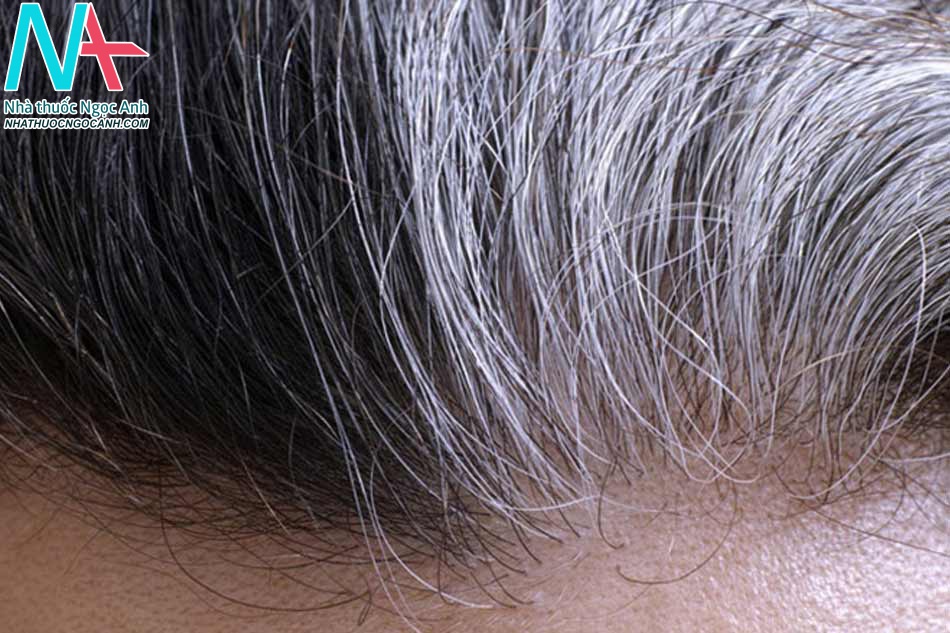 Nguyên nhân tóc bạc sớm