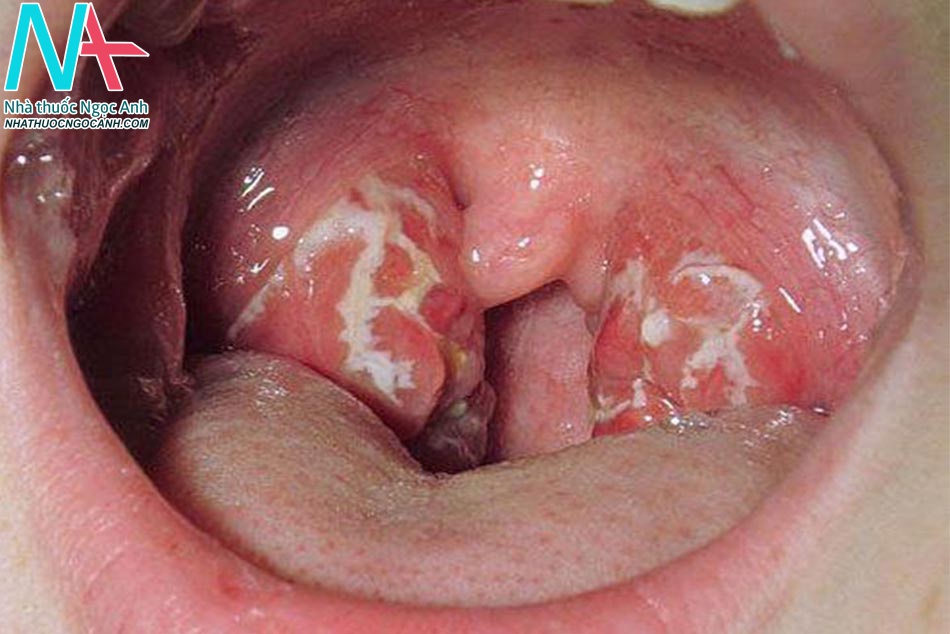 Hình ảnh ung thư vòm họng