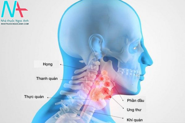 Dấu hiệu nhận biết của ung thư vòm họng giai đoạn 2