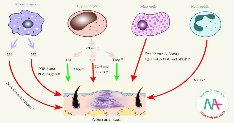Vai trò của các tế bào viêm trong hình thành sẹo lồi