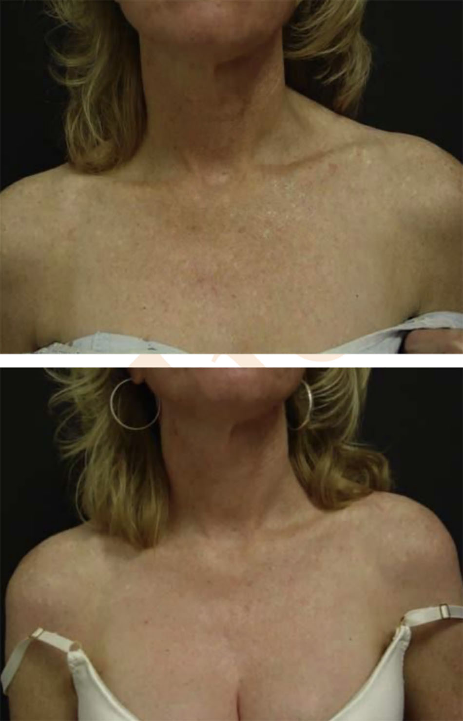 Hình 6.8 Trước( hình trên) và sau peel trichloroacetic acid Blue vùng ngực