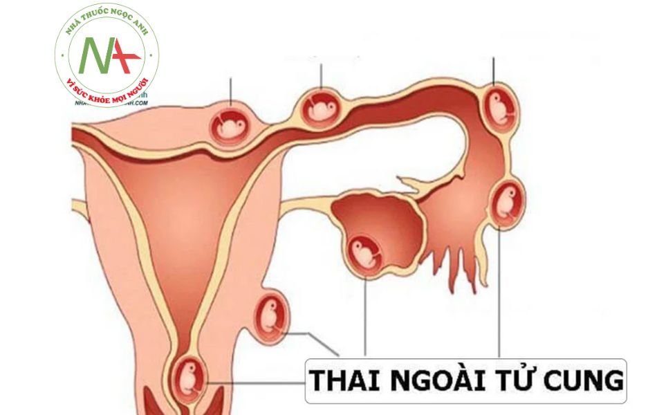 Thế nào là mang thai ngoài tử cung?