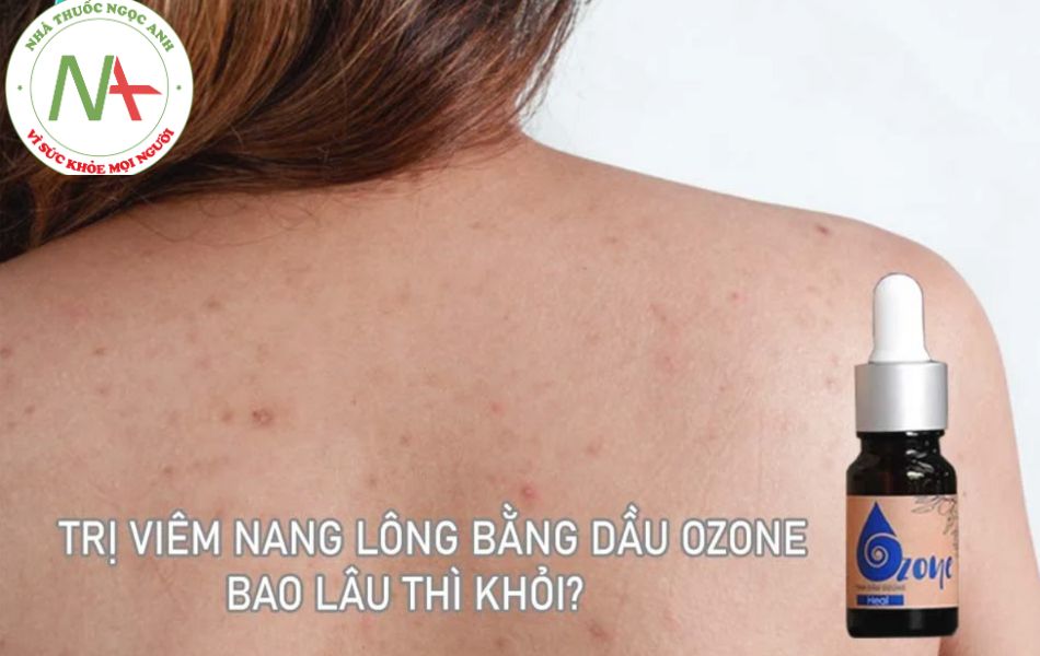 Trị viêm nang lông bằng dầu Ozone bao lâu thì khỏi?