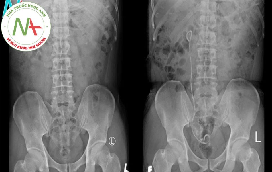 Hình ảnh chụp X-quang trước và sau khi tán sỏi thận qua da