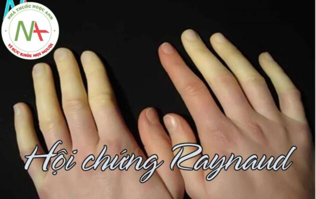 Hội chứng Raynaud là gì?