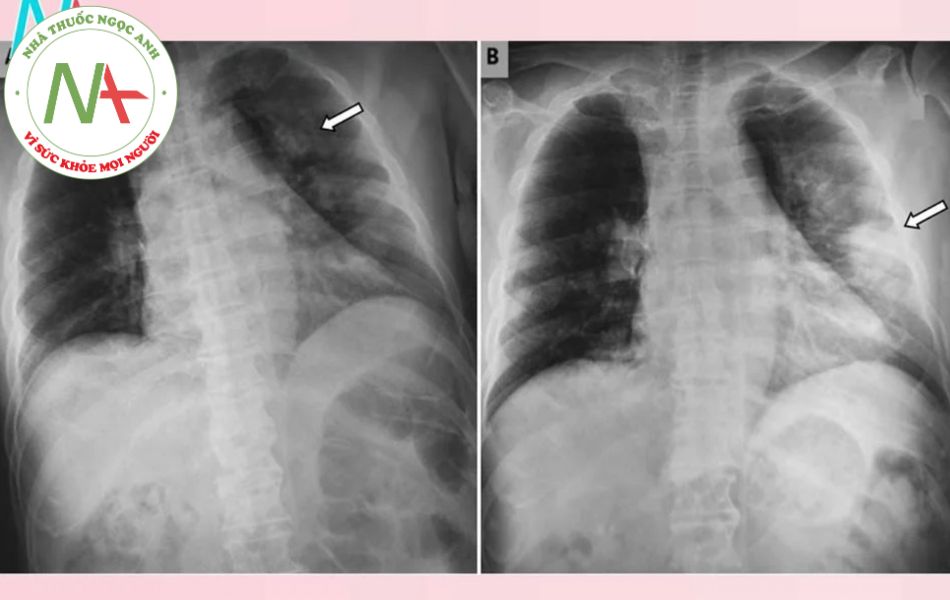 Hình ảnh X-quang của viêm phổi kẽ
