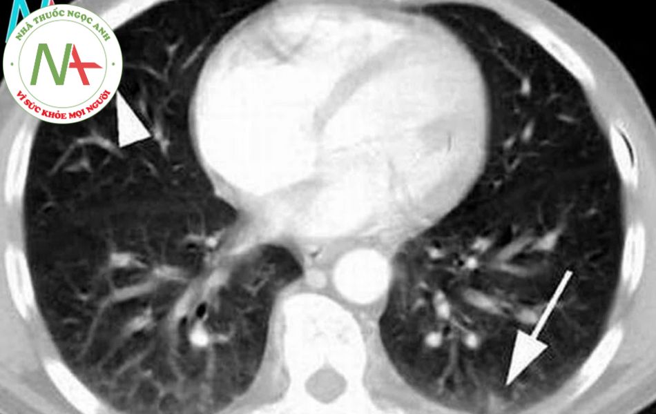 Bệnh viêm phổi kẽ chữa được không?