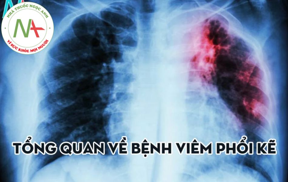 Bệnh viêm phổi kẽ là gì?