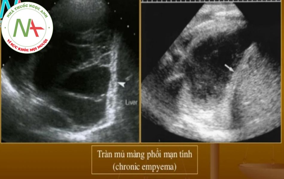 Hình ảnh siêu âm Tràn mủ màng phổi