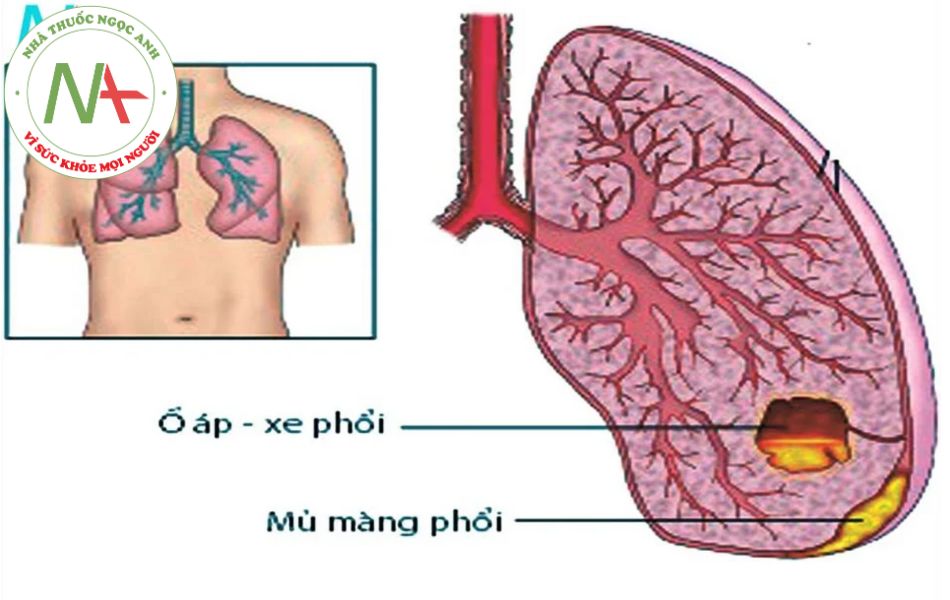 Hình ảnh áp xe phổi trong Tràn mủ màng phổi