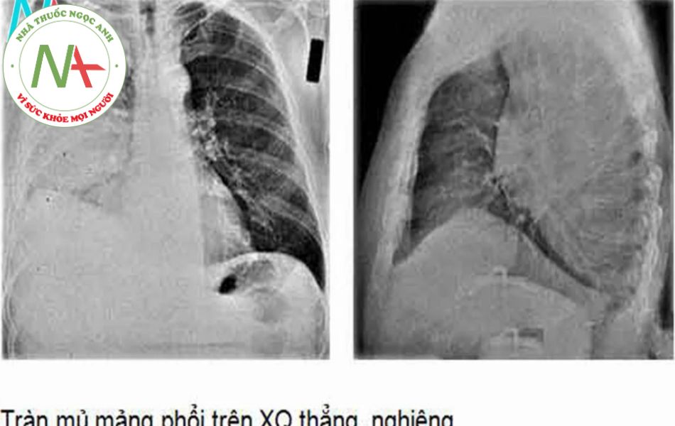 Hình ảnh chụp X-quang của Tràn mủ màng phổi