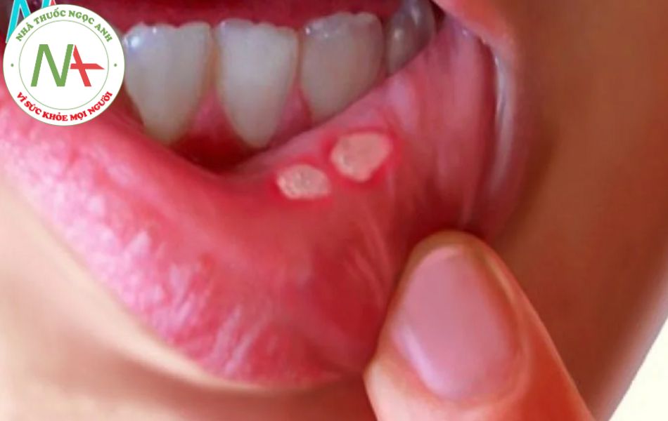 Vết loét ở miệng của bệnh nhân mắc Aphtose