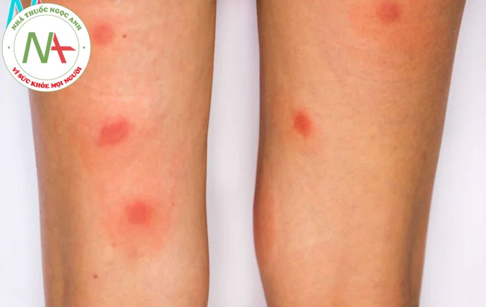 Hình ảnh các vết mẩn đỏ trên chân của bệnh nhân mắc Lyme