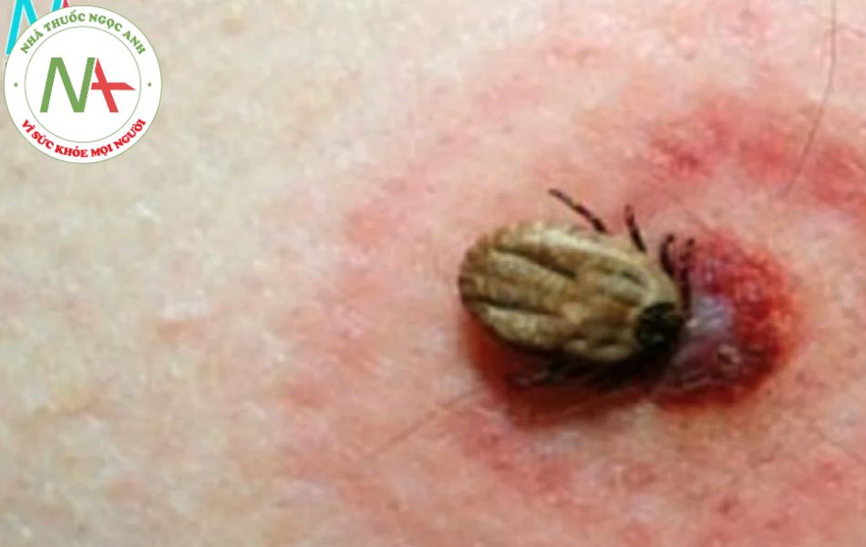 Nguyên nhân gây bệnh Lyme