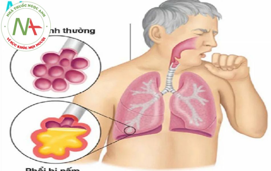 Bệnh Nấm phổi
