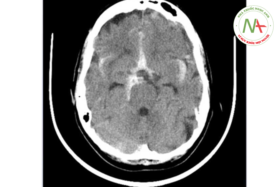 Hình chụp CT đầu không cản quang