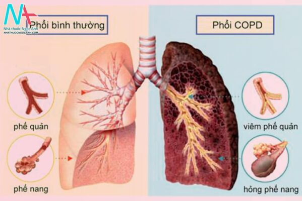 Bệnh phổi tắc nghẽn mạn tính là gì?