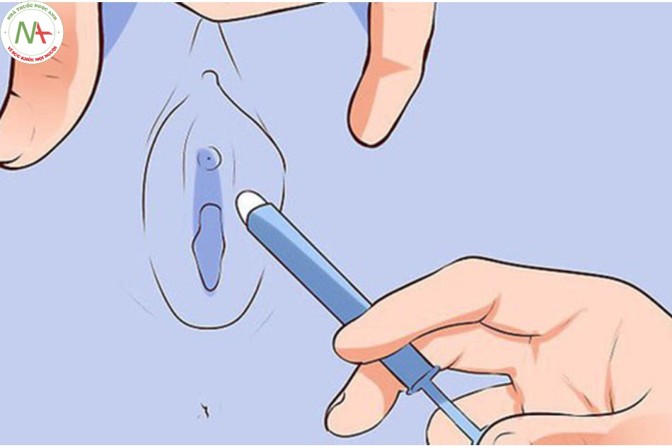 Cách đặt thuốc âm đạo có dụng cụ bơm