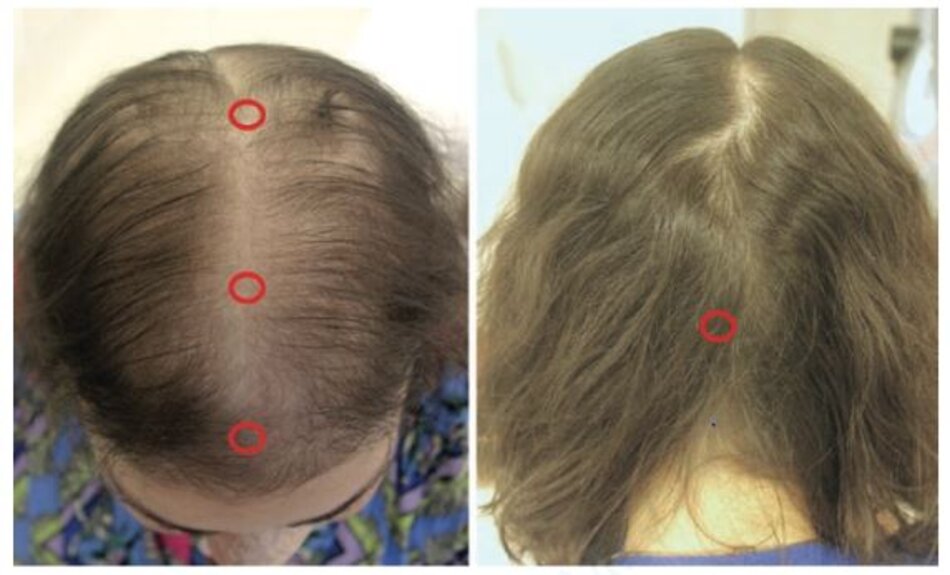Hình 1.1 Các vị trí kiểm tra ở bệnh nhân rụng tóc lan toả hoặc từng mảng.